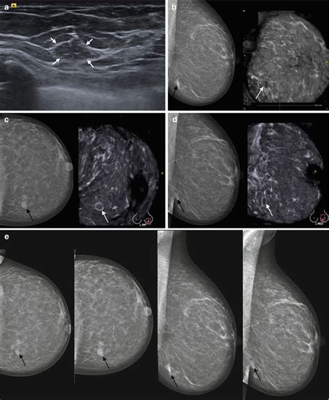 ābvs|abvs breast.